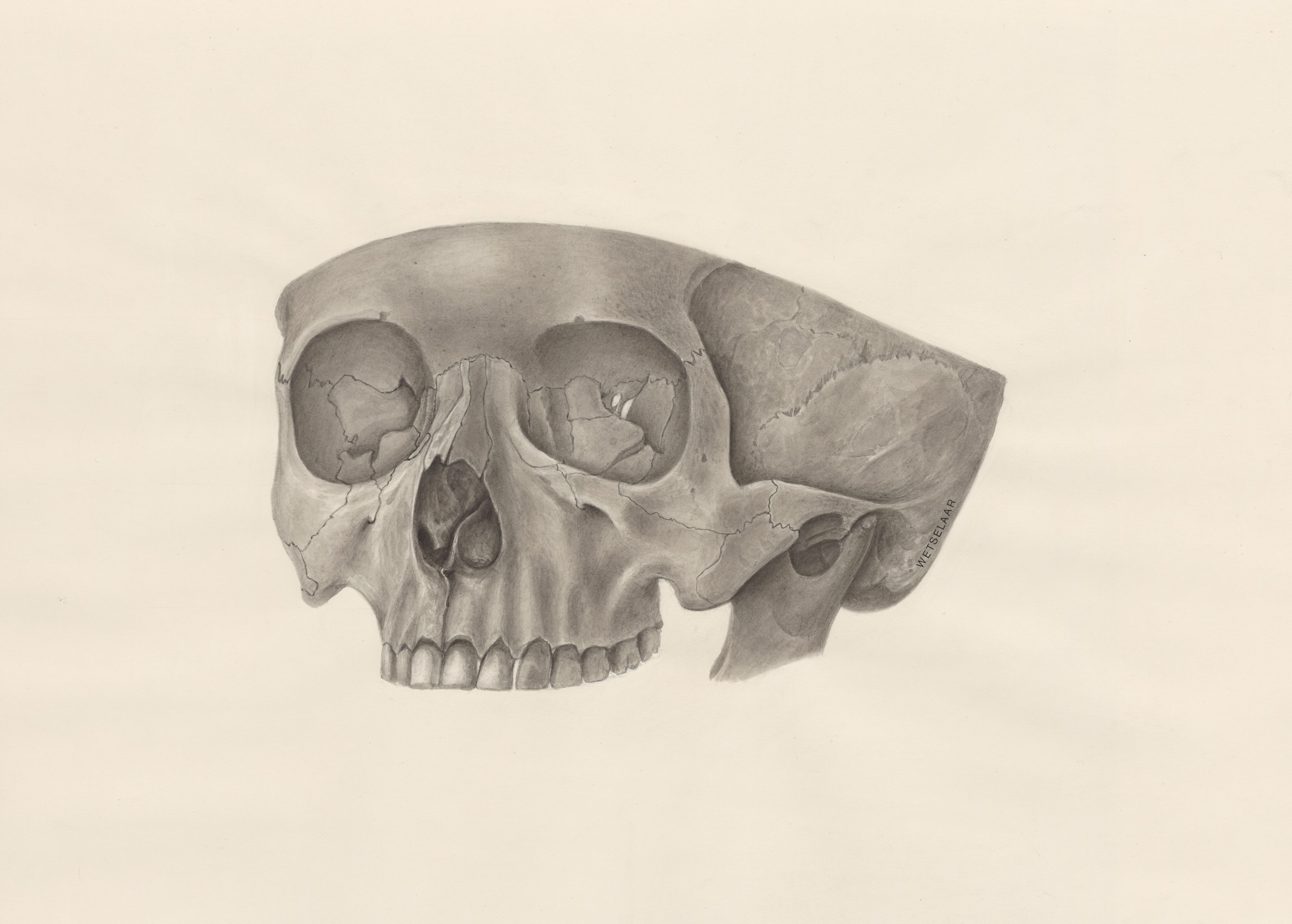 Deformed fetal skull