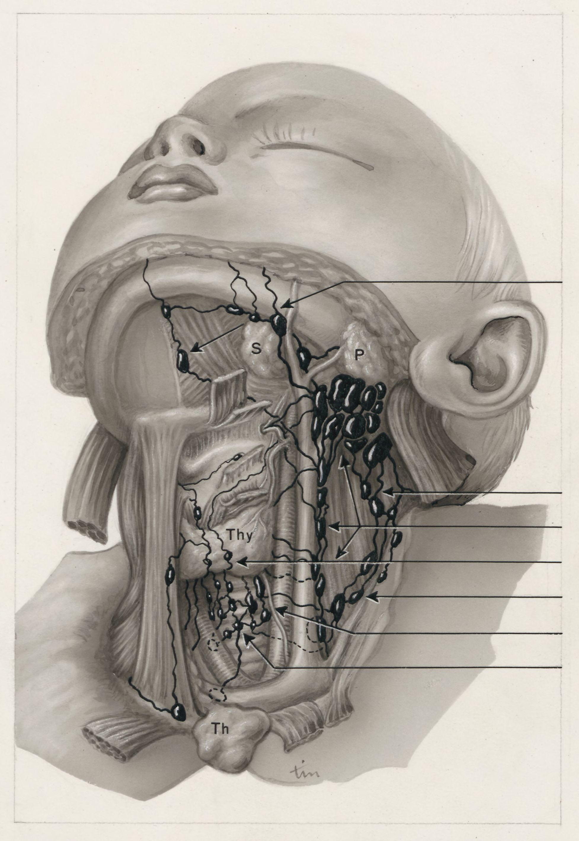 Neck surgery