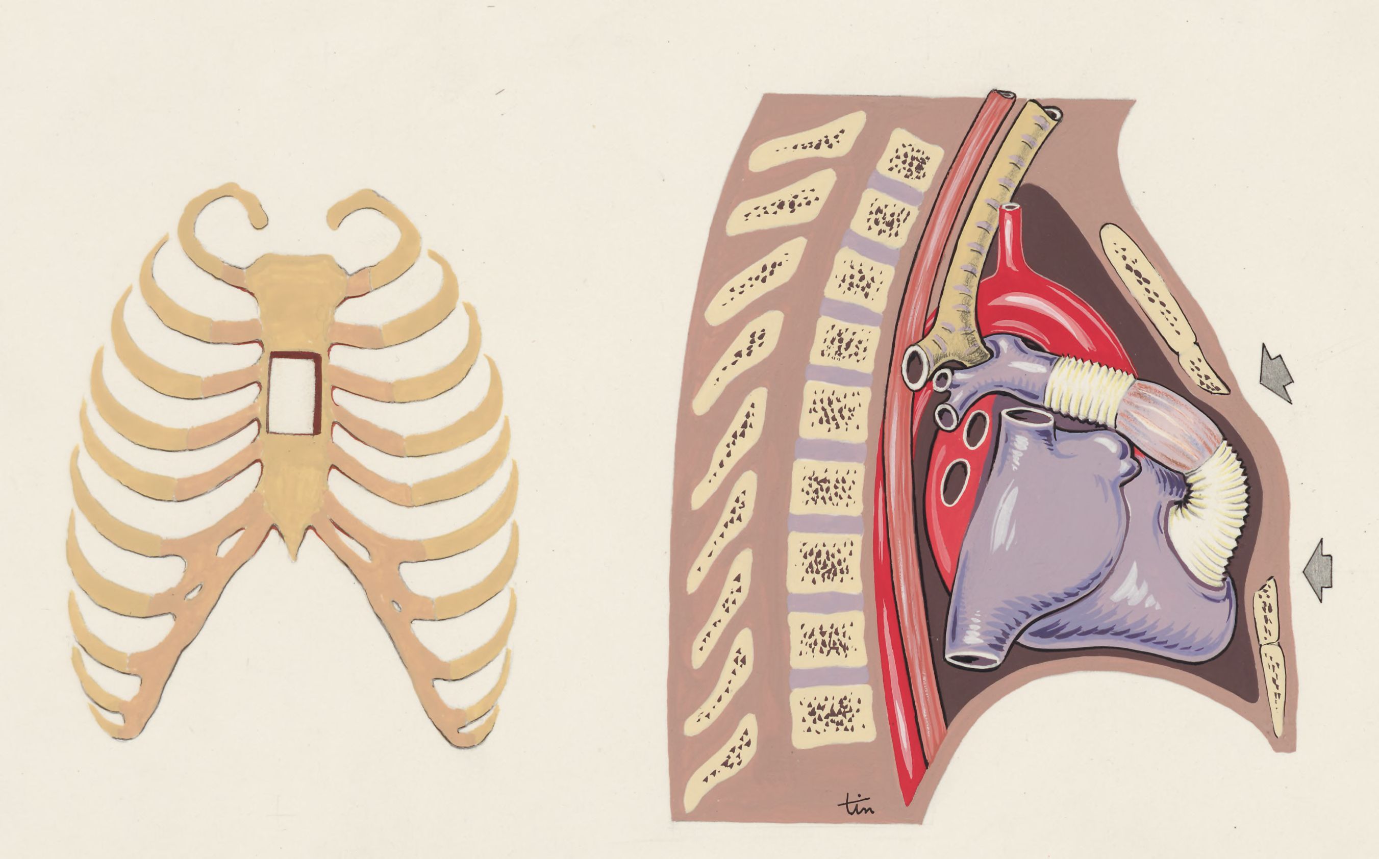 Thorax surgery