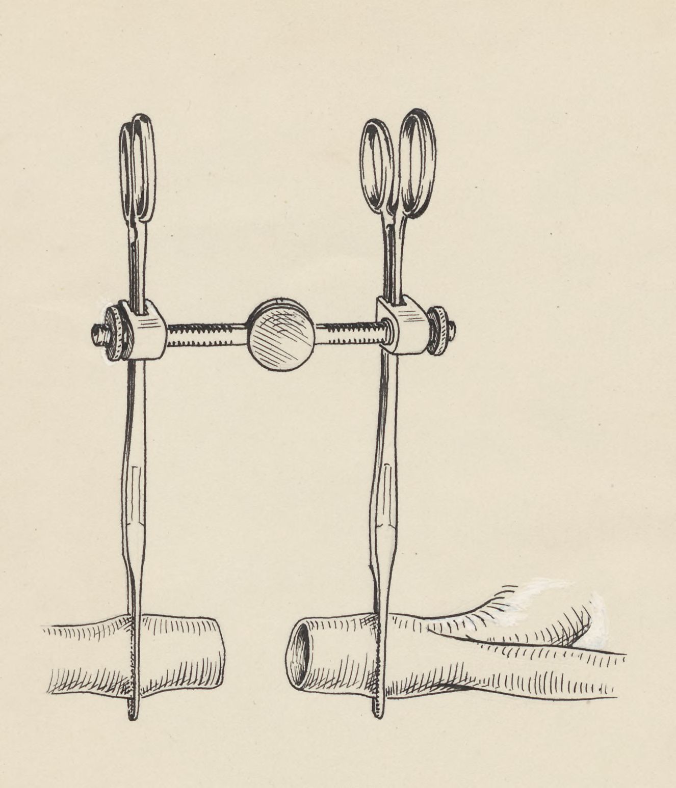 Vascular surgery