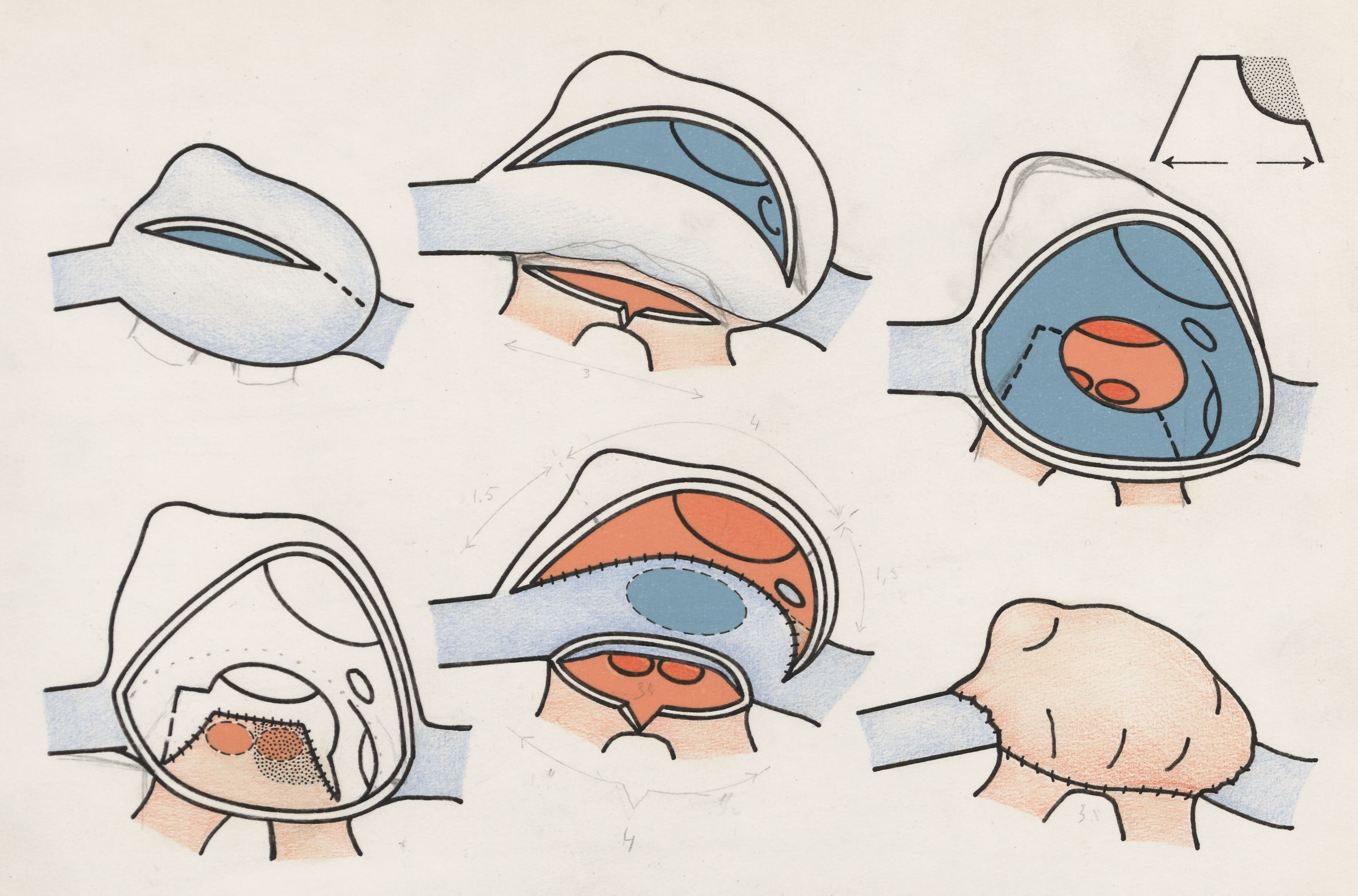 Surgical procedure