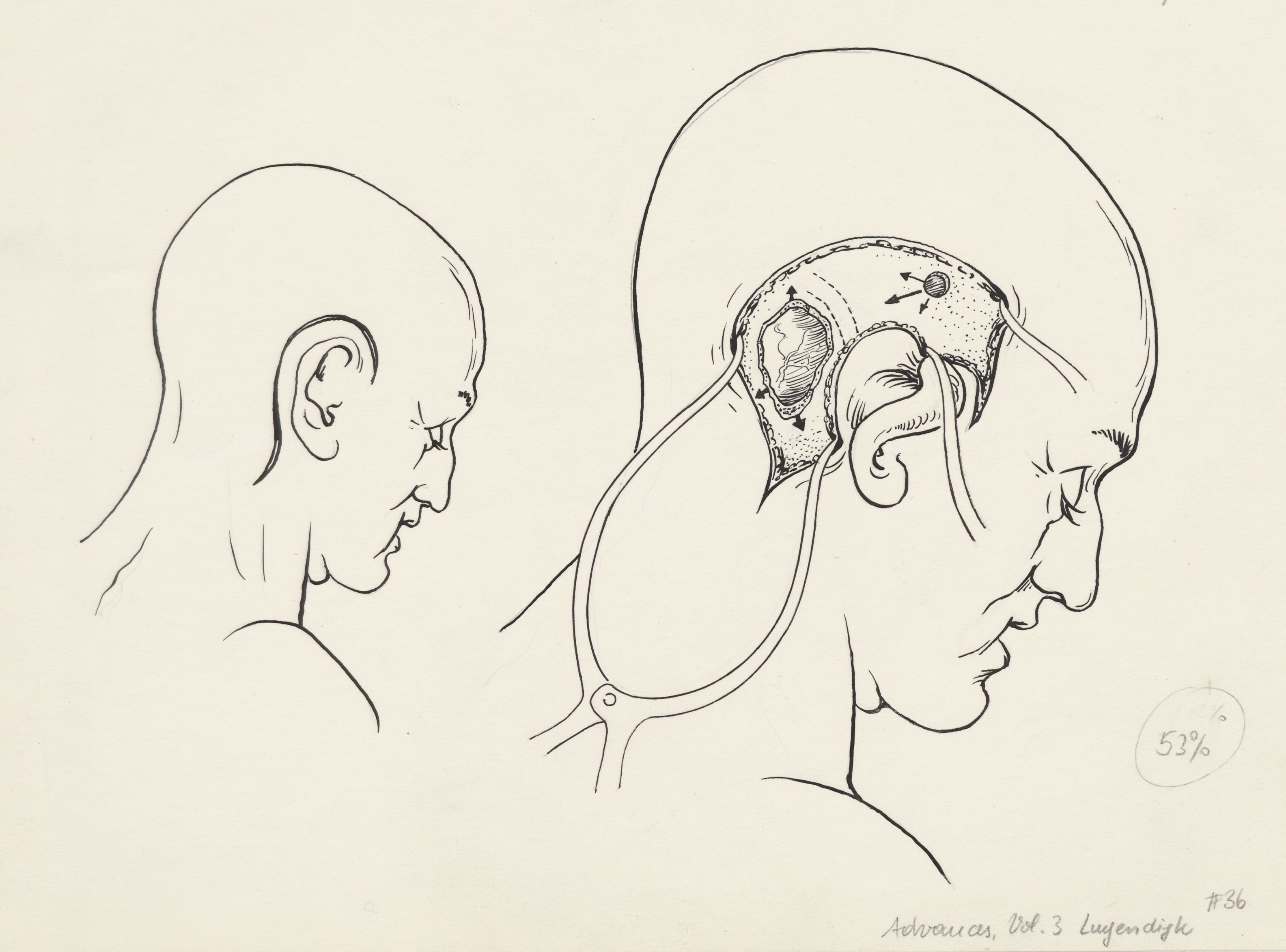 Neurosurgical Procedures