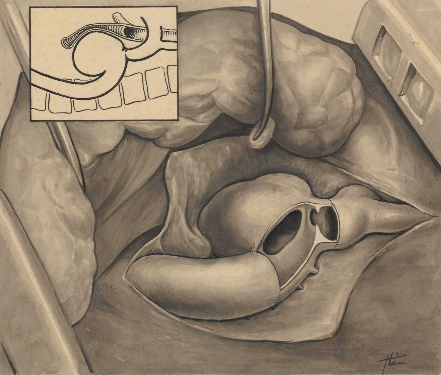 Thorax surgery