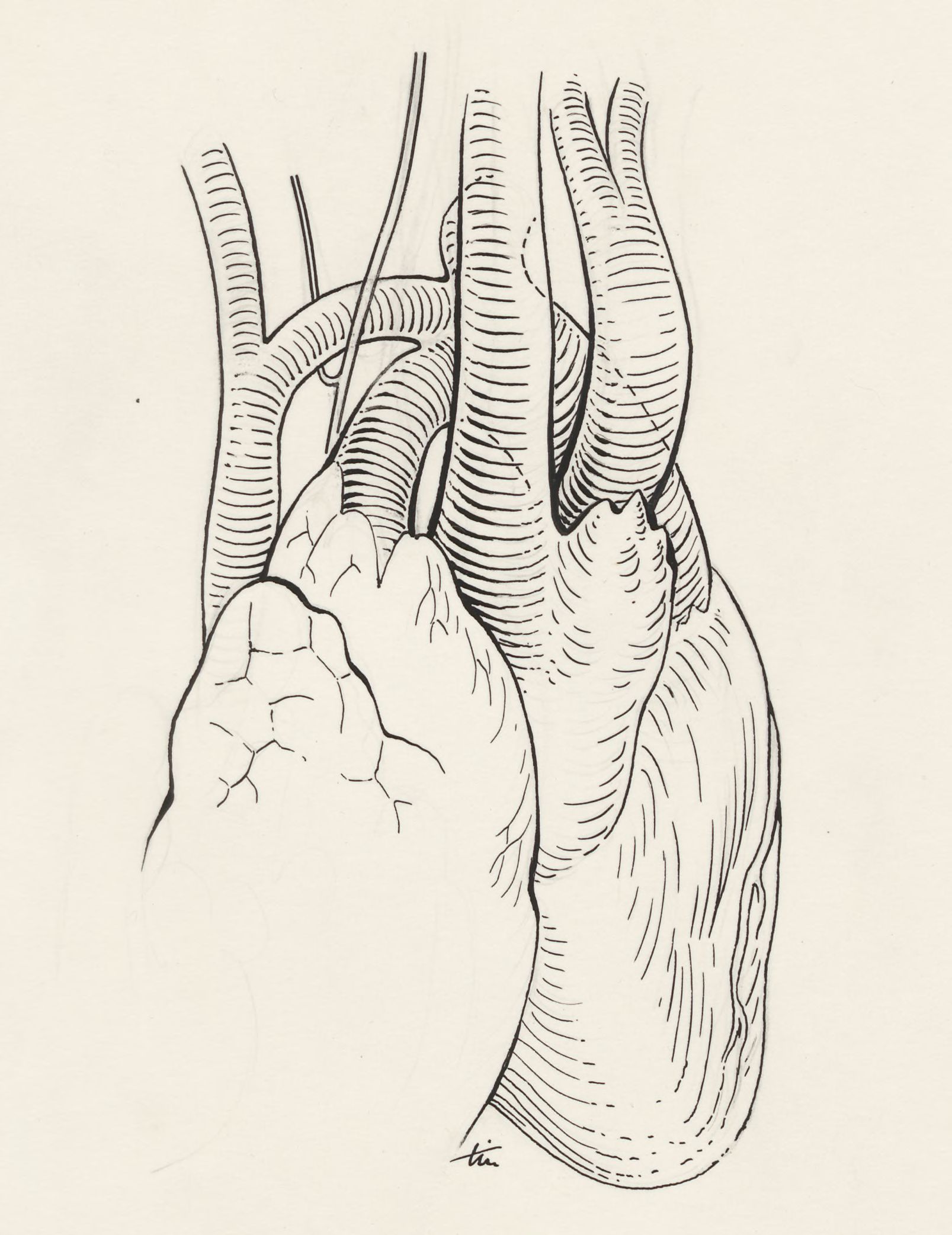 Aortic surgery