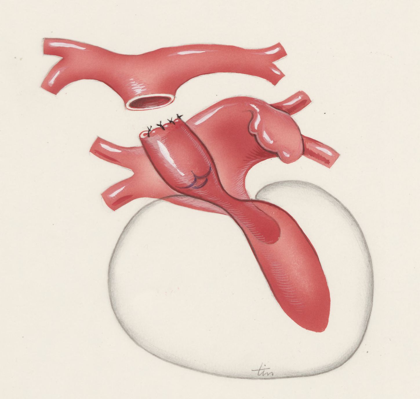 Thorax surgery