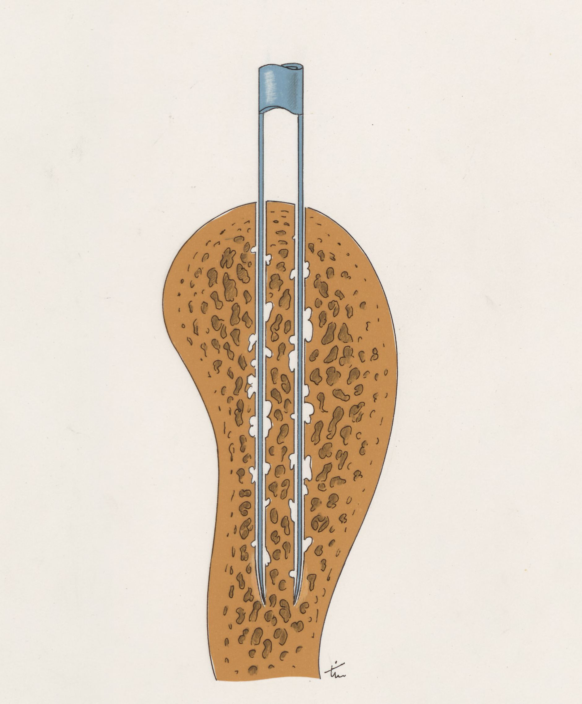 Bone drilling technique