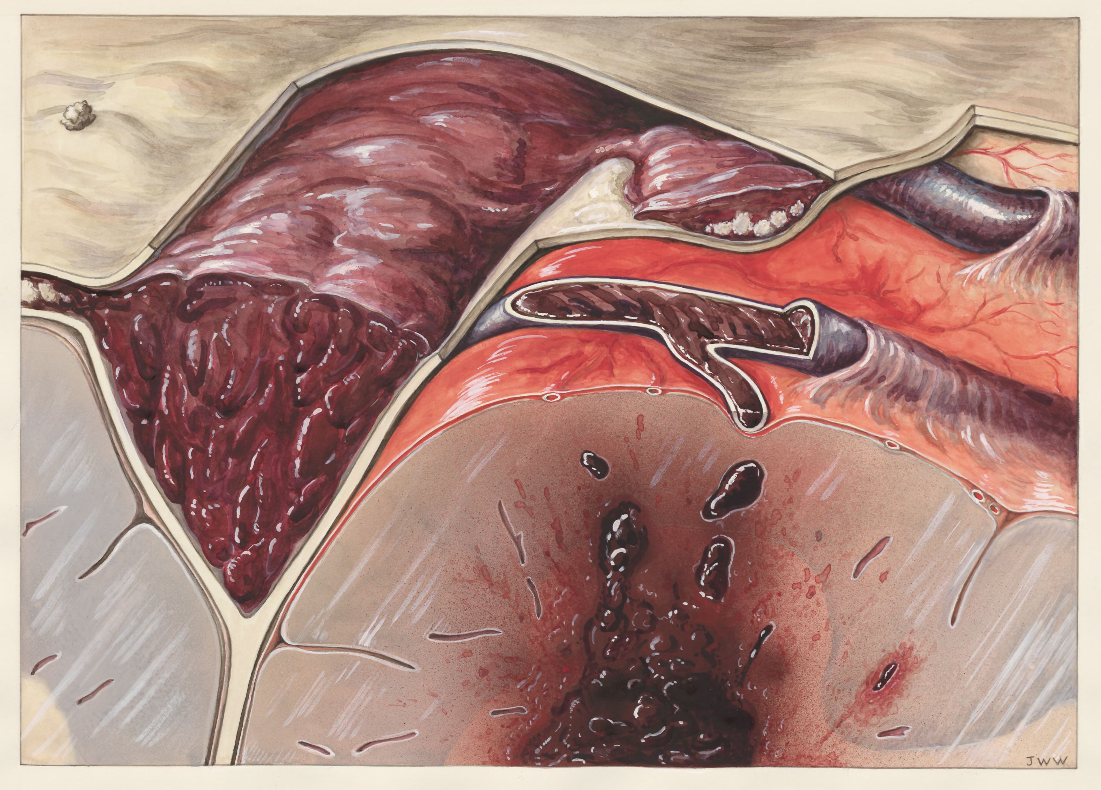Sick human tissue relating to thrombosis