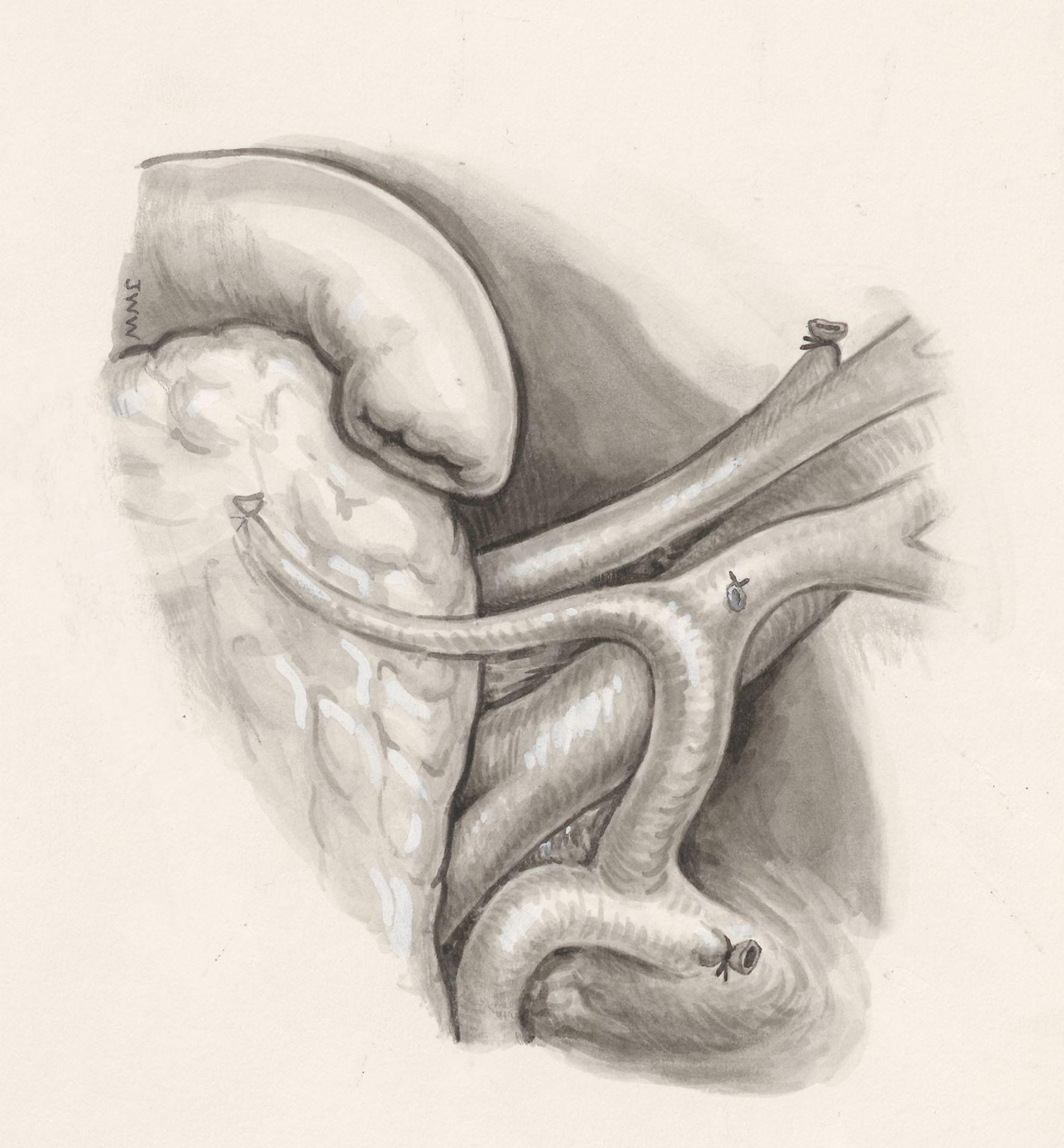 Surgery on a part of the human body