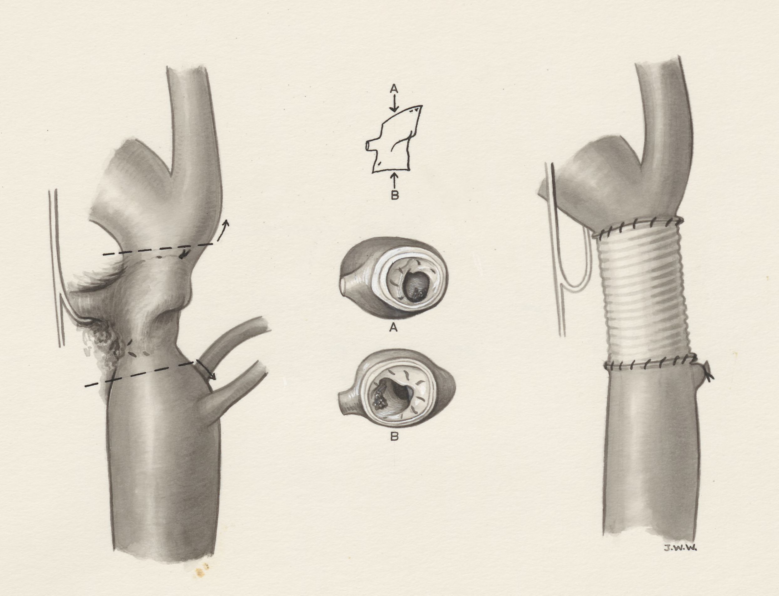 Heart surgery