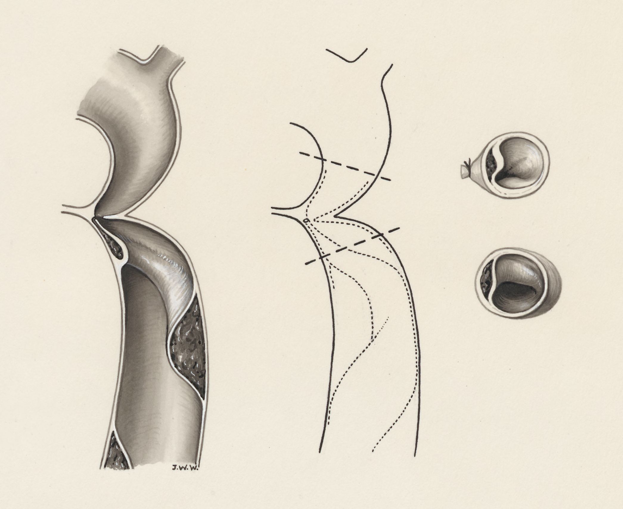 Heart surgery