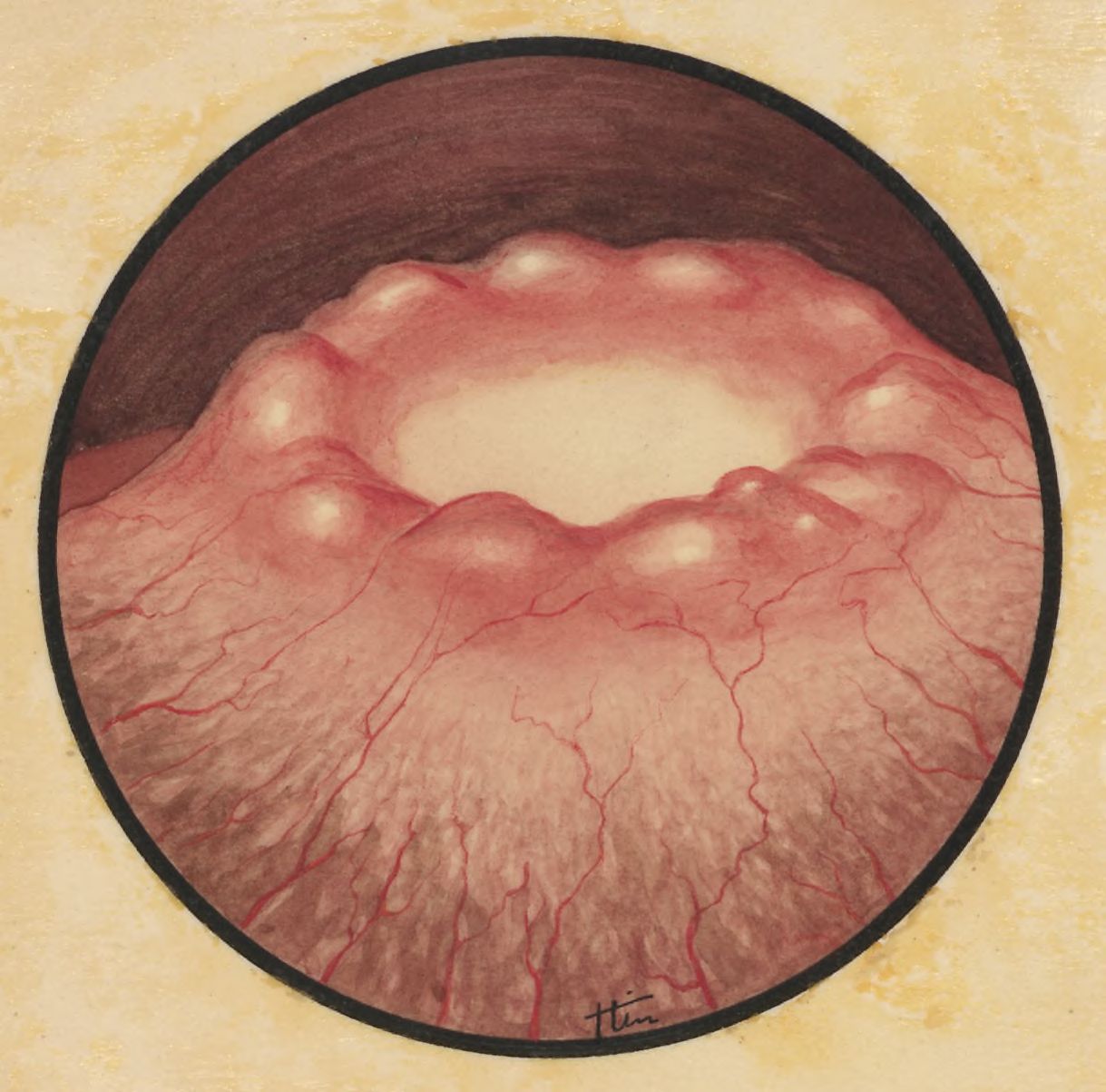 Microscopic magnification of an inflammation on human tissue