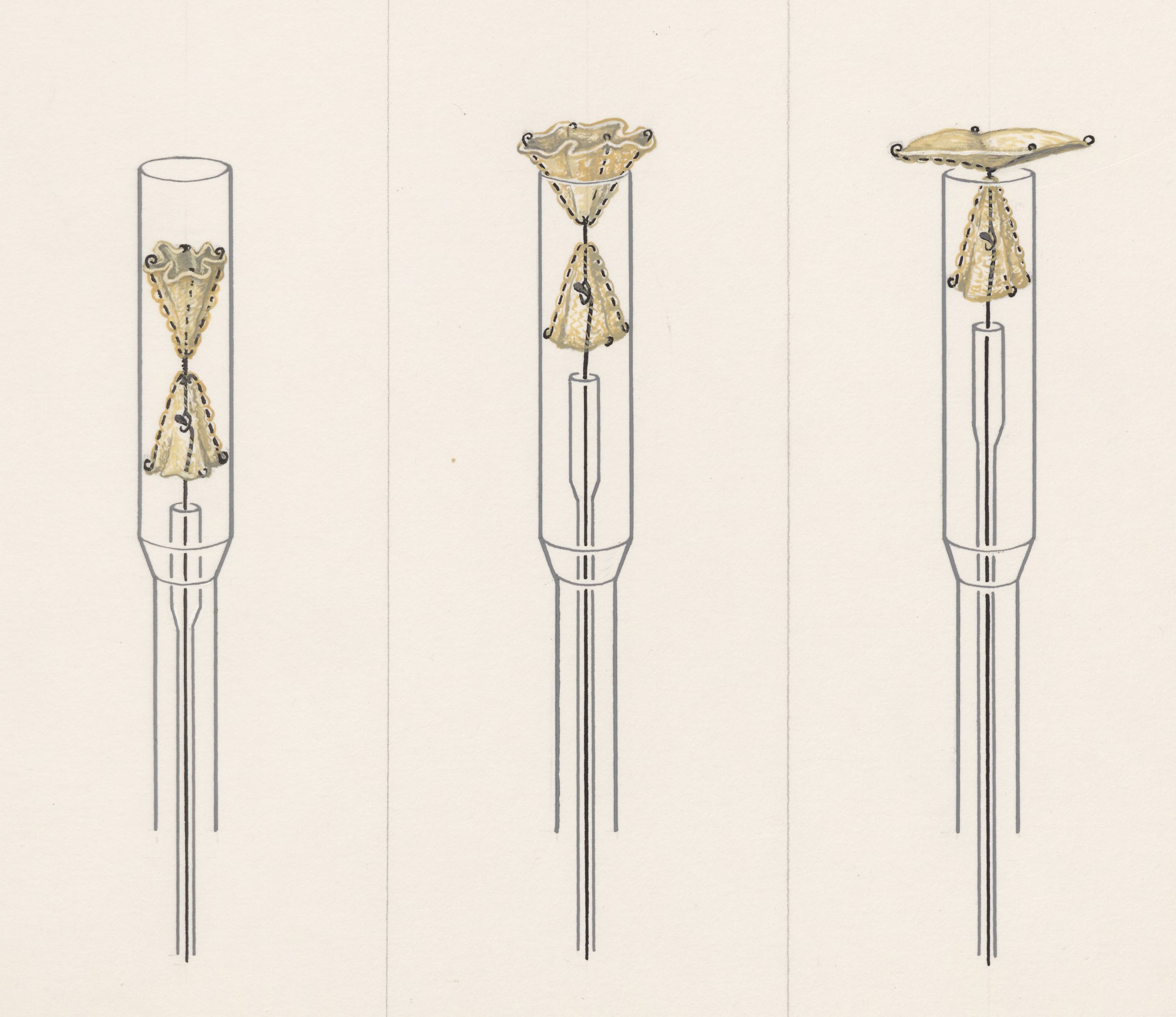 Procedure to open the artery around the heart of young children, devised by Dr. J. Rohmer