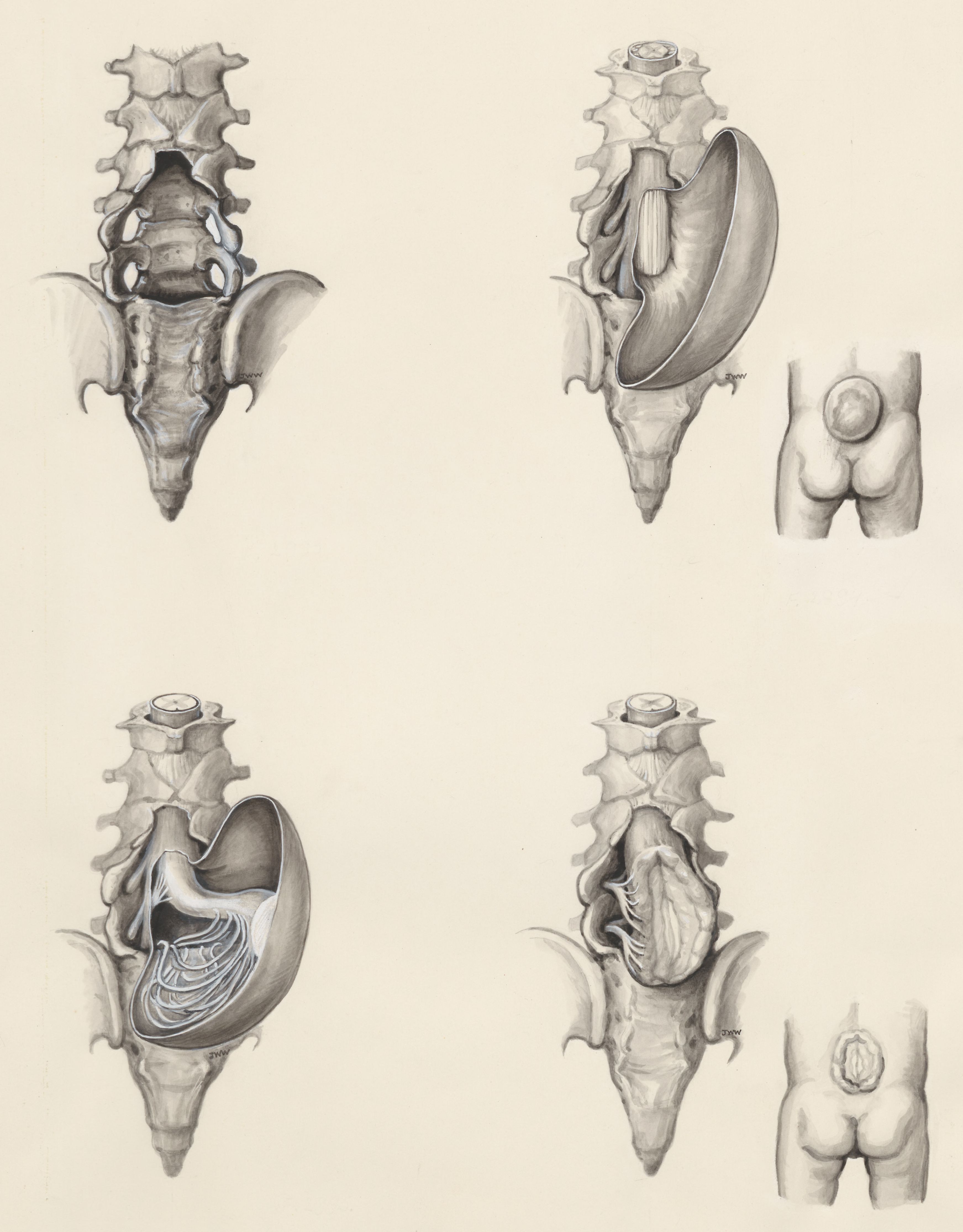 Protrusion of the lower back