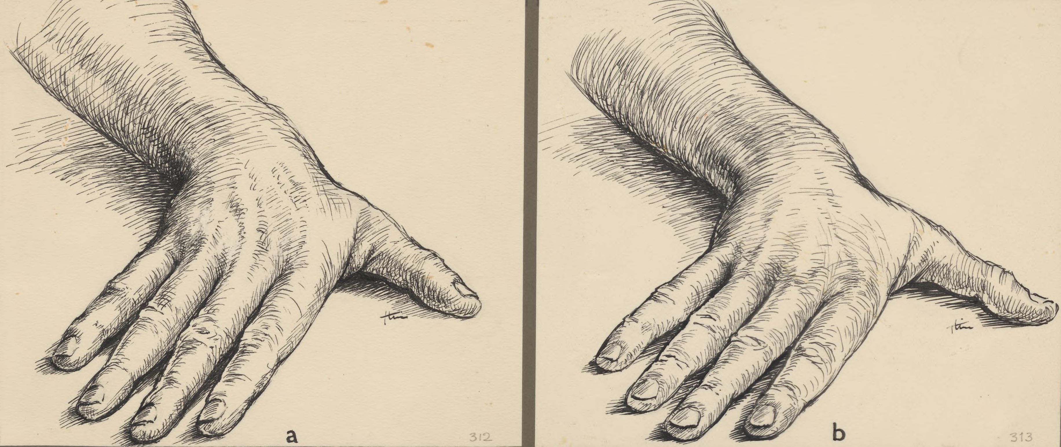 Two studies of the hand of dr. Landsmeer