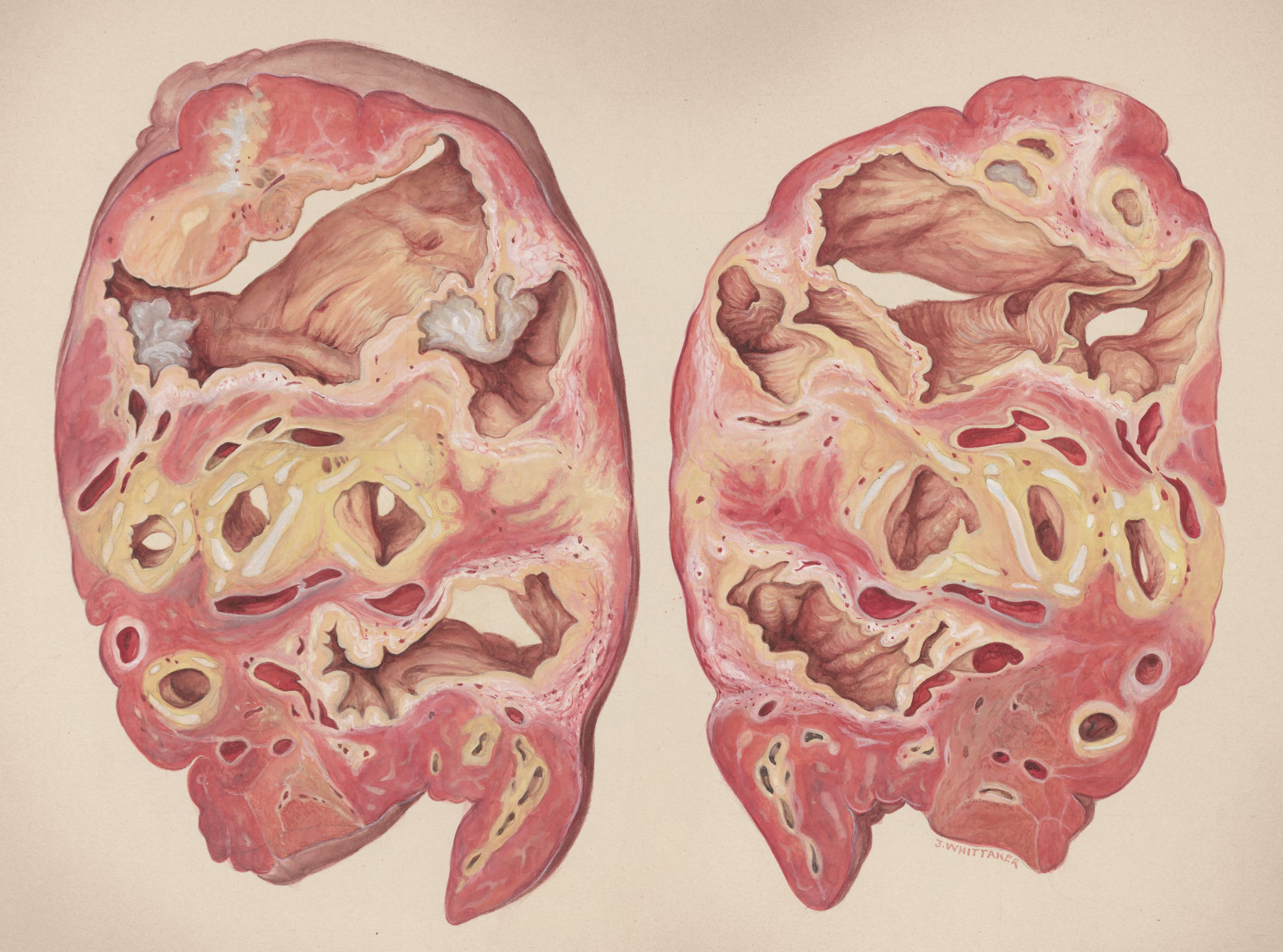 Lung tissue