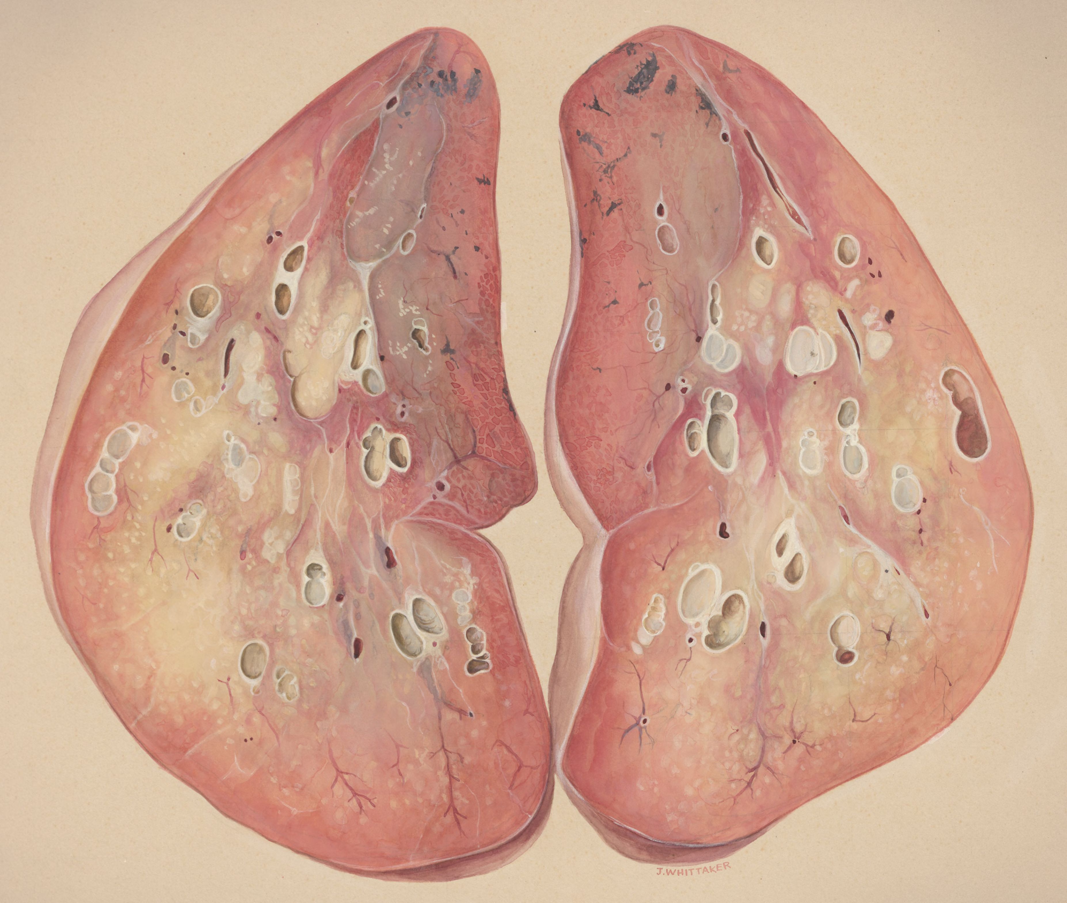 Lung tissue