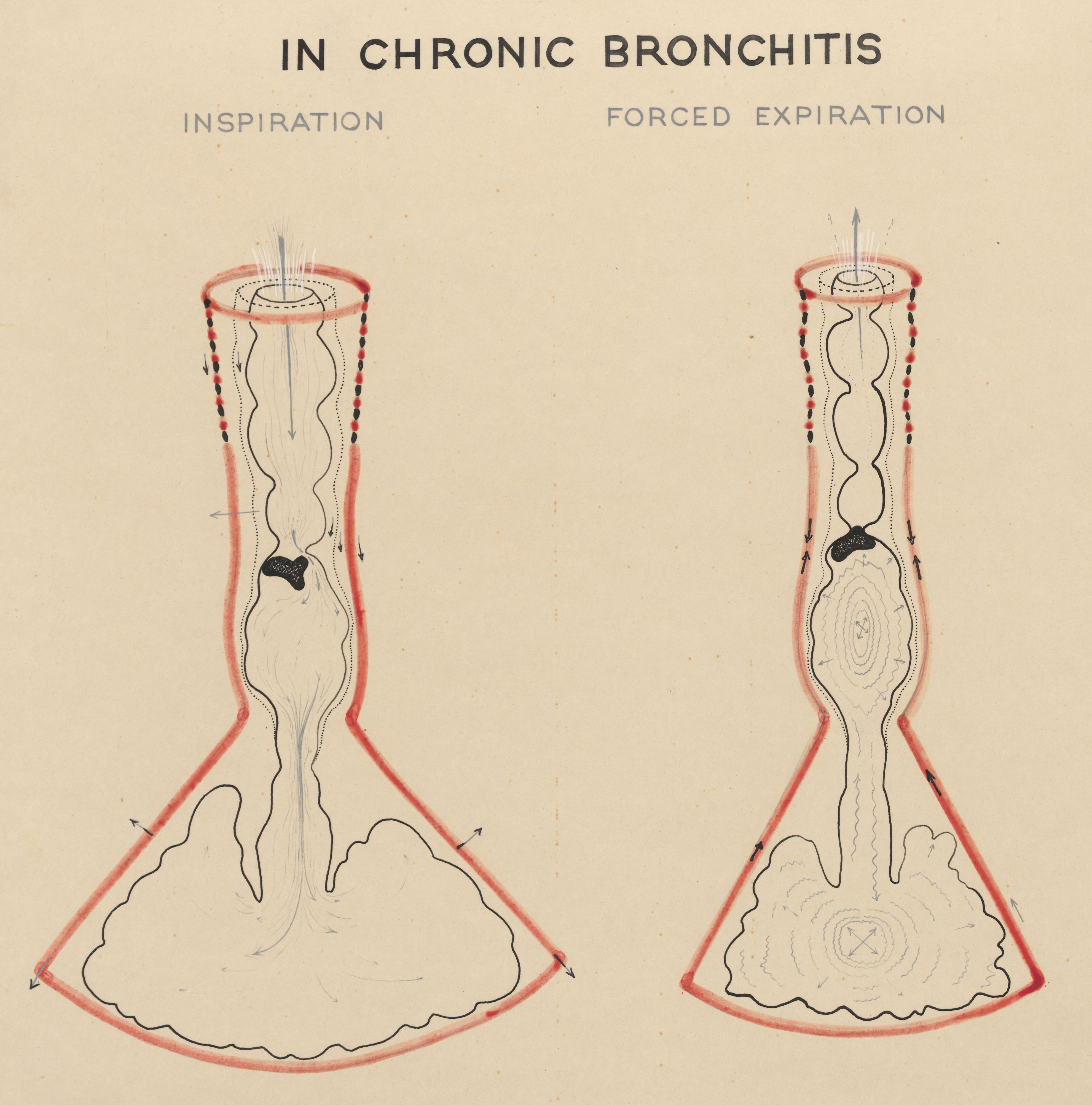 Schematic representation of chronic bronchitis