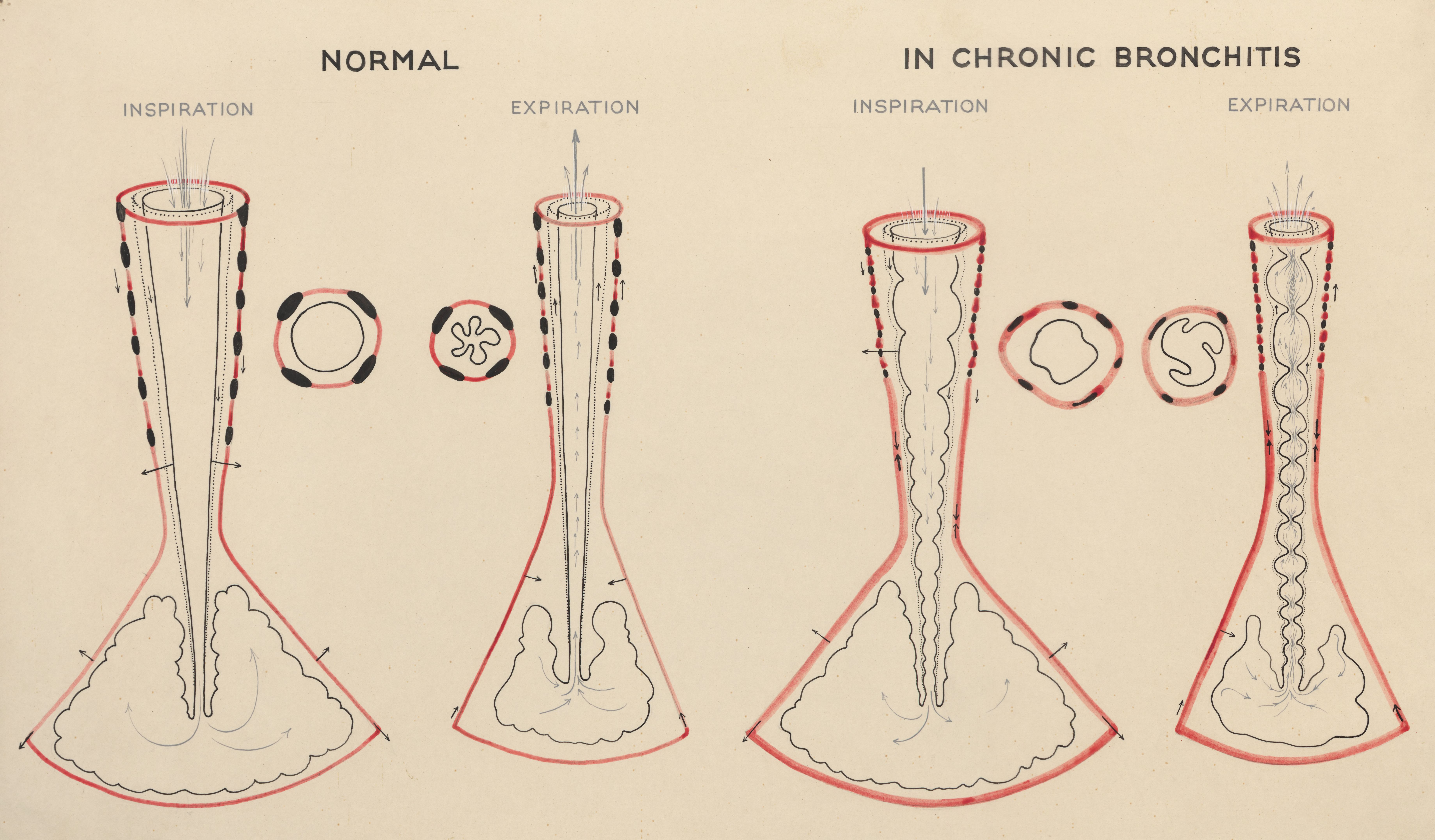 Schematic representation of chronic bronchitis