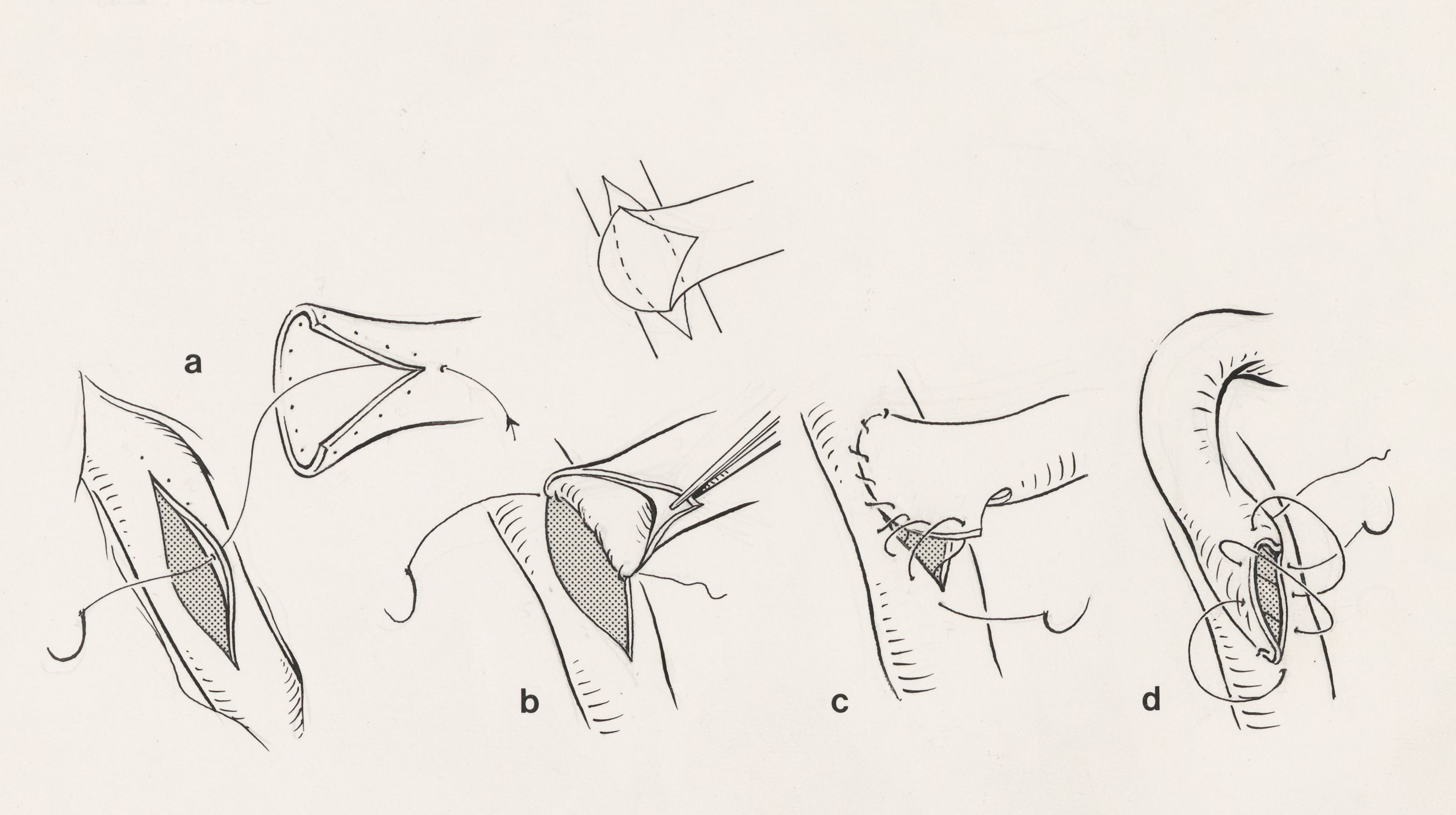 Thorax surgery