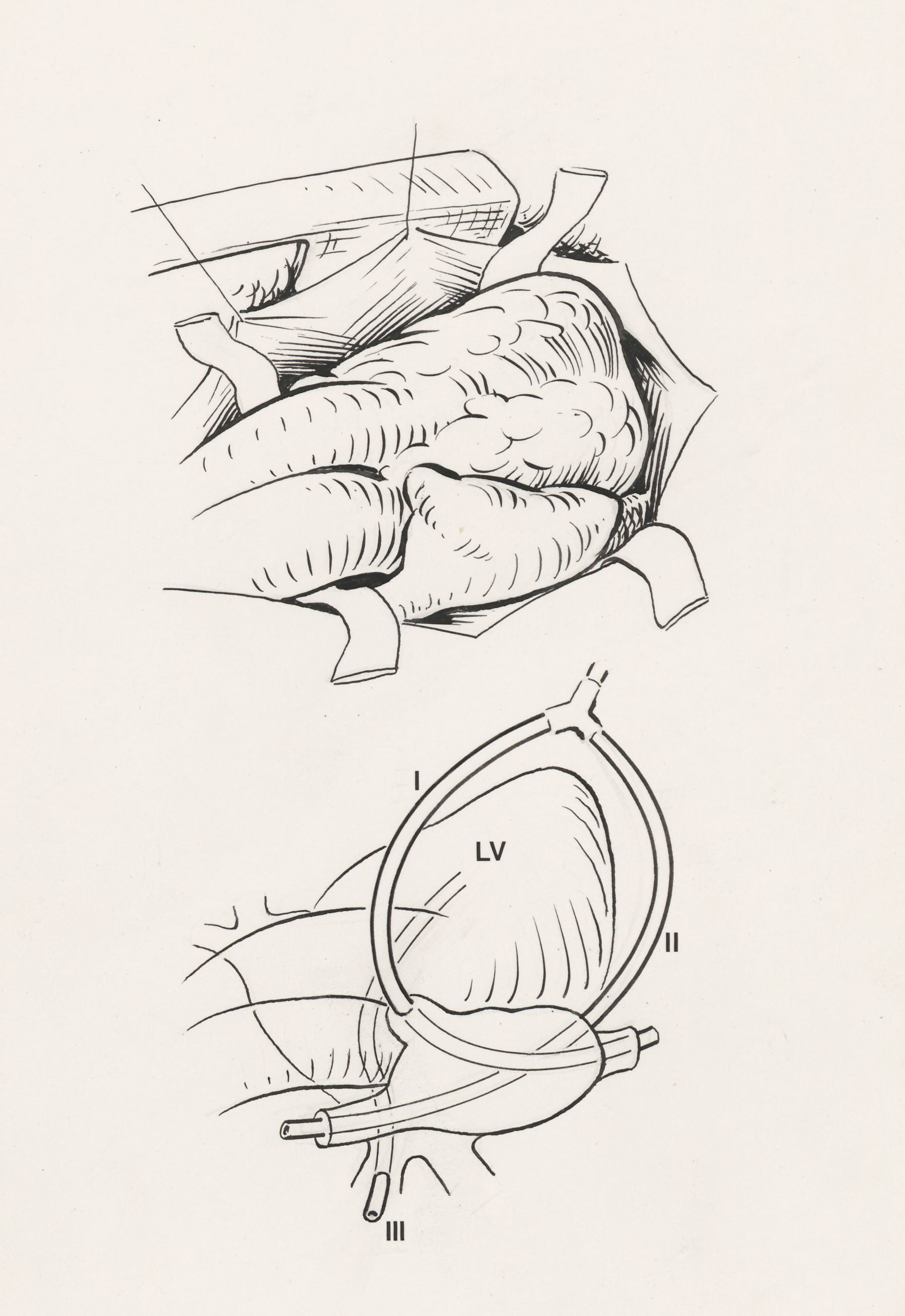 Thorax surgery