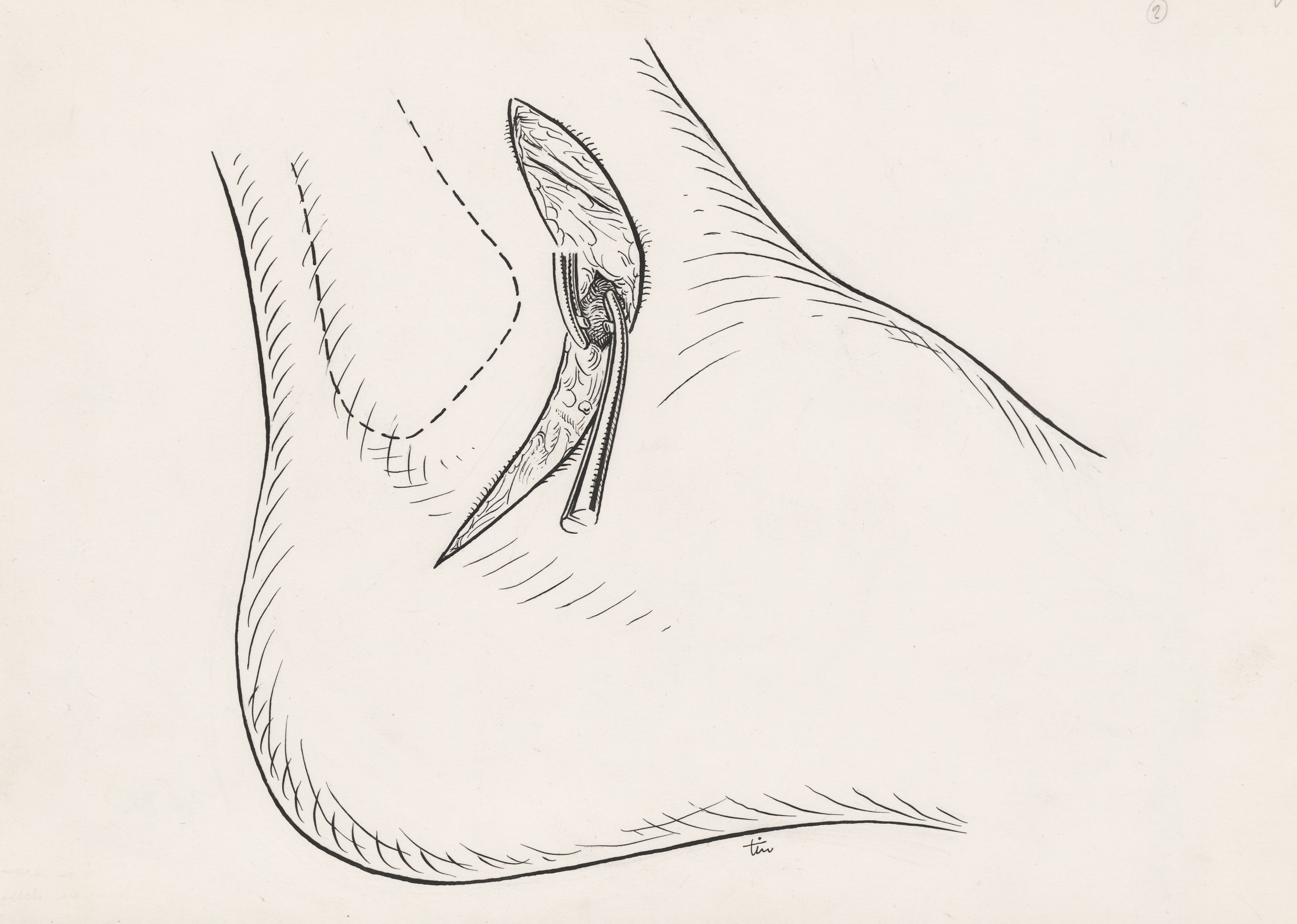 Surgery of the ankle ligament