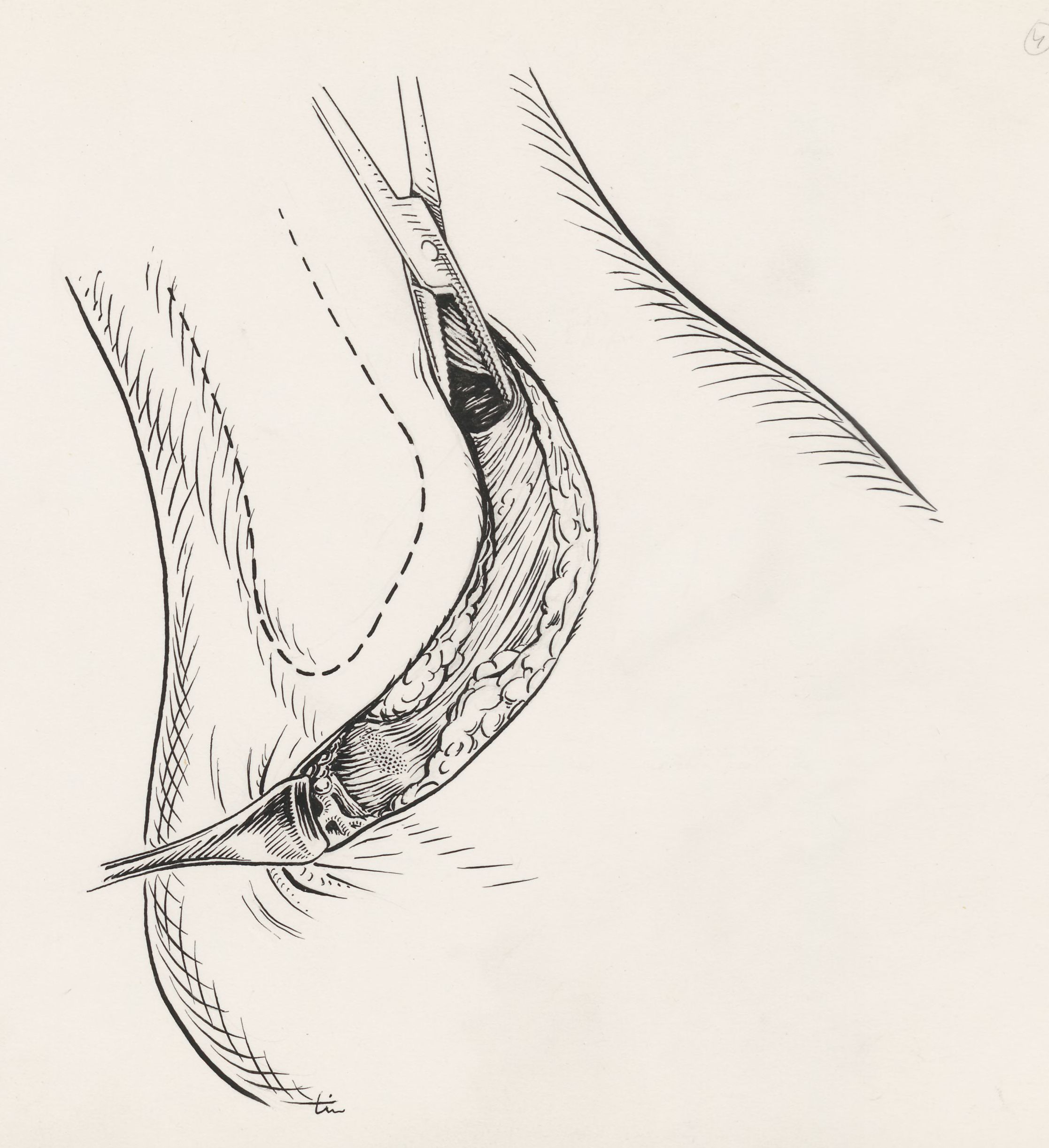 Surgery of the ankle ligament