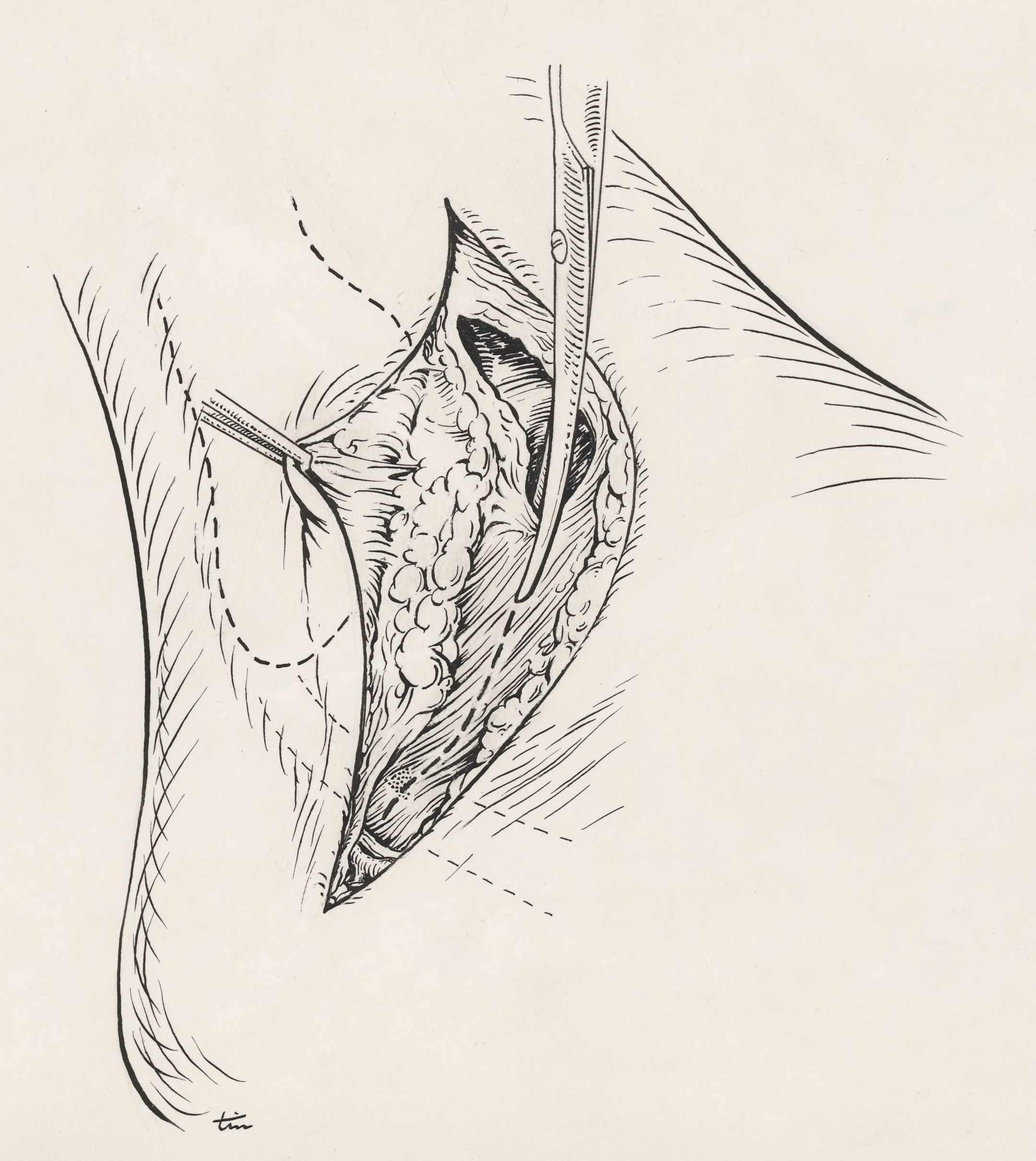 Surgery of the ankle ligament