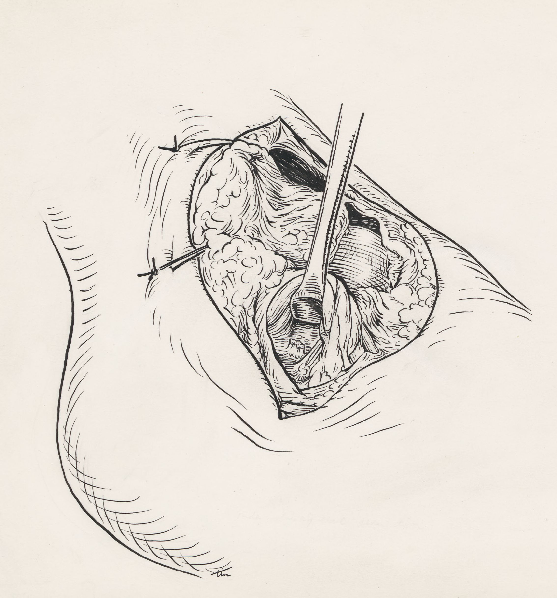 Surgery of the ankle ligament