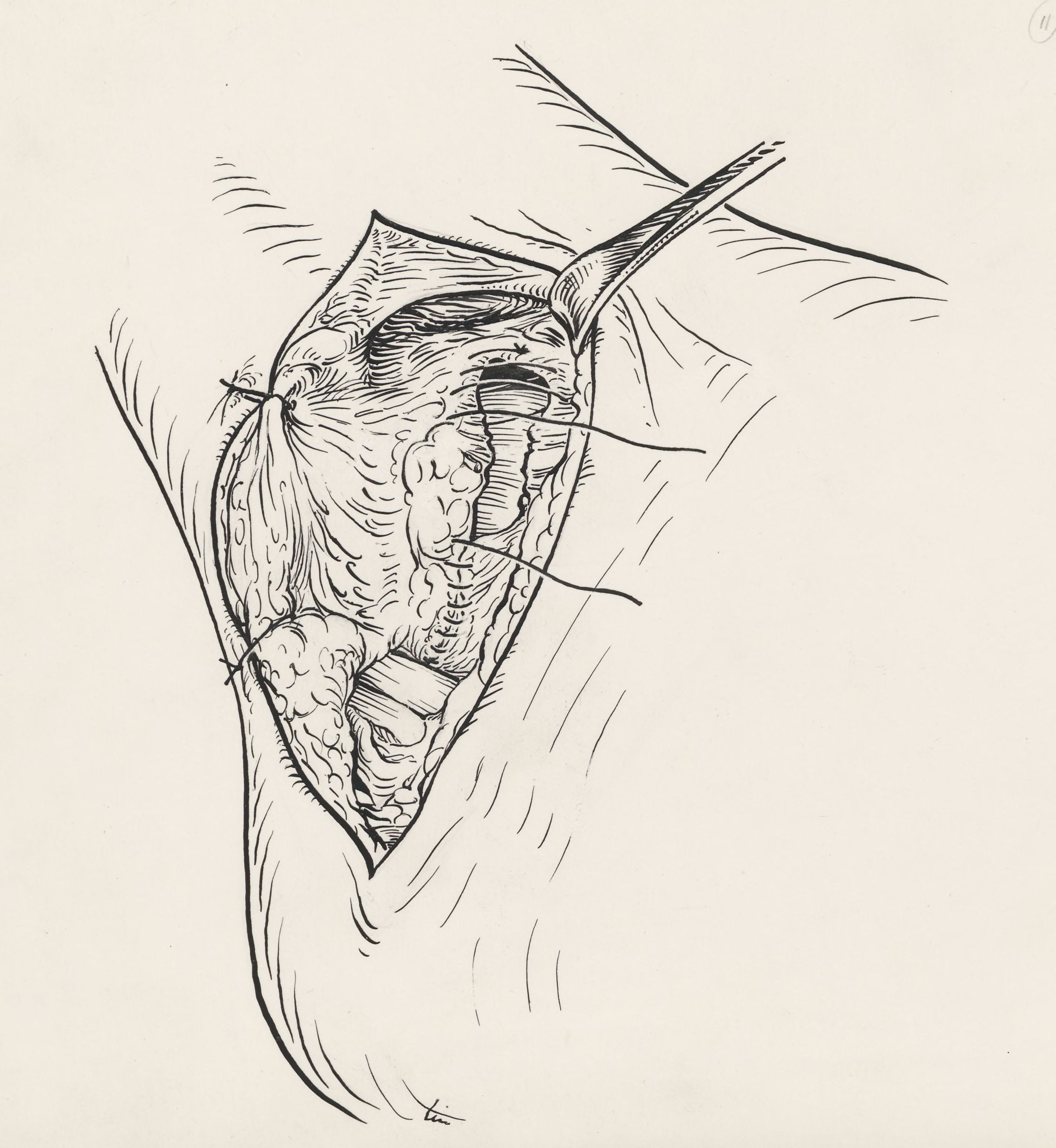 Surgery of the ankle ligament