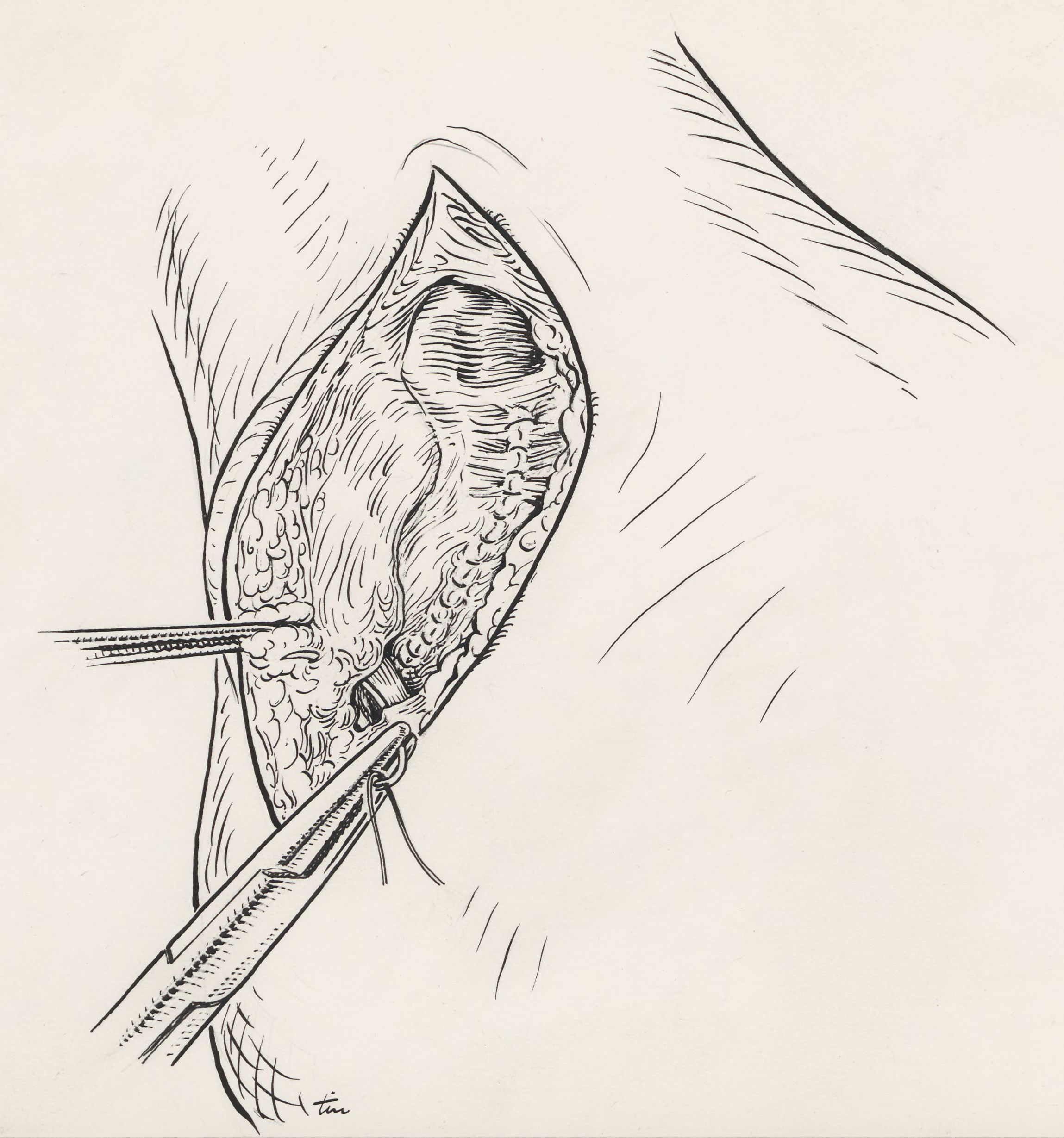 Surgery of the ankle ligament