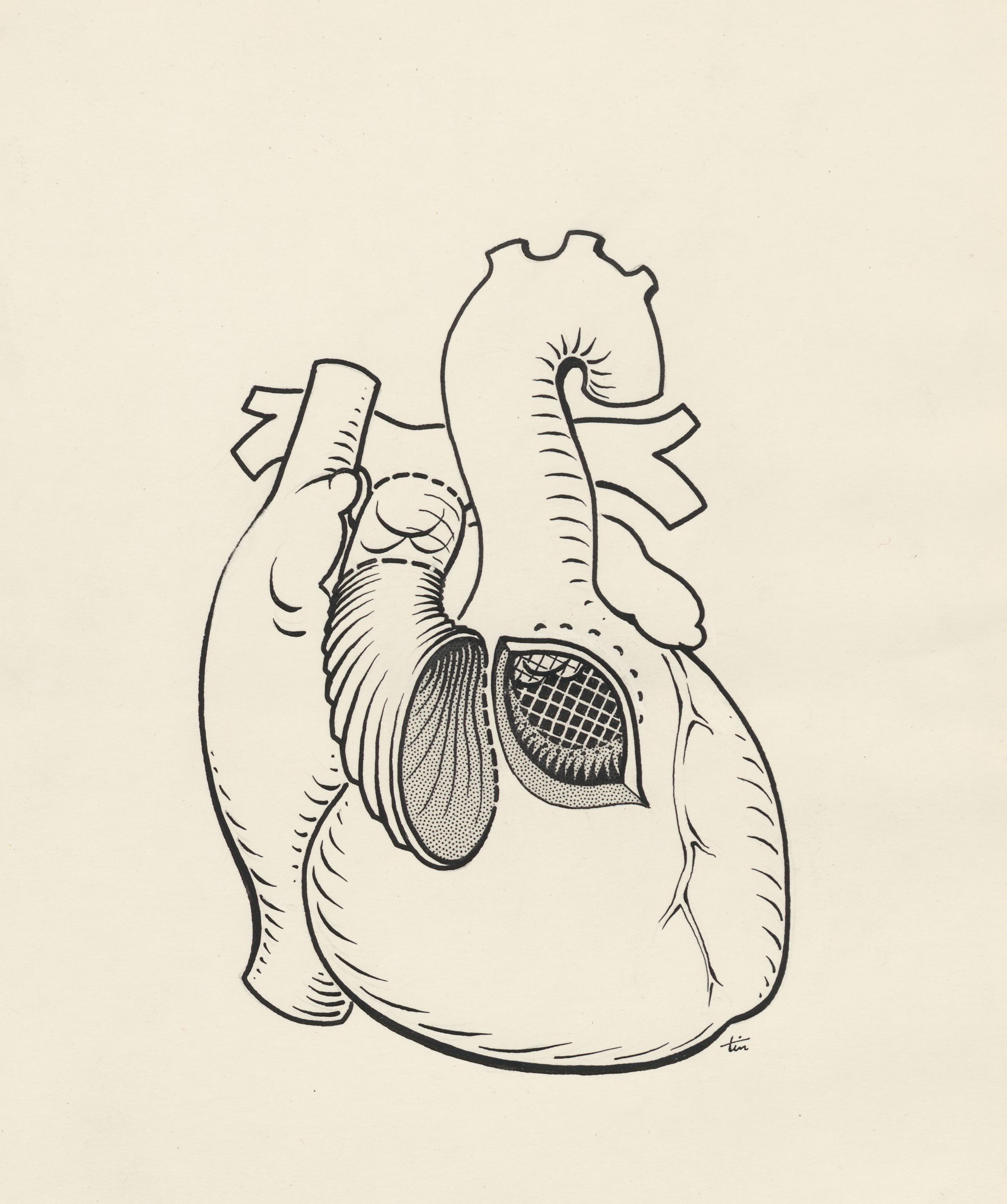 Heart surgery