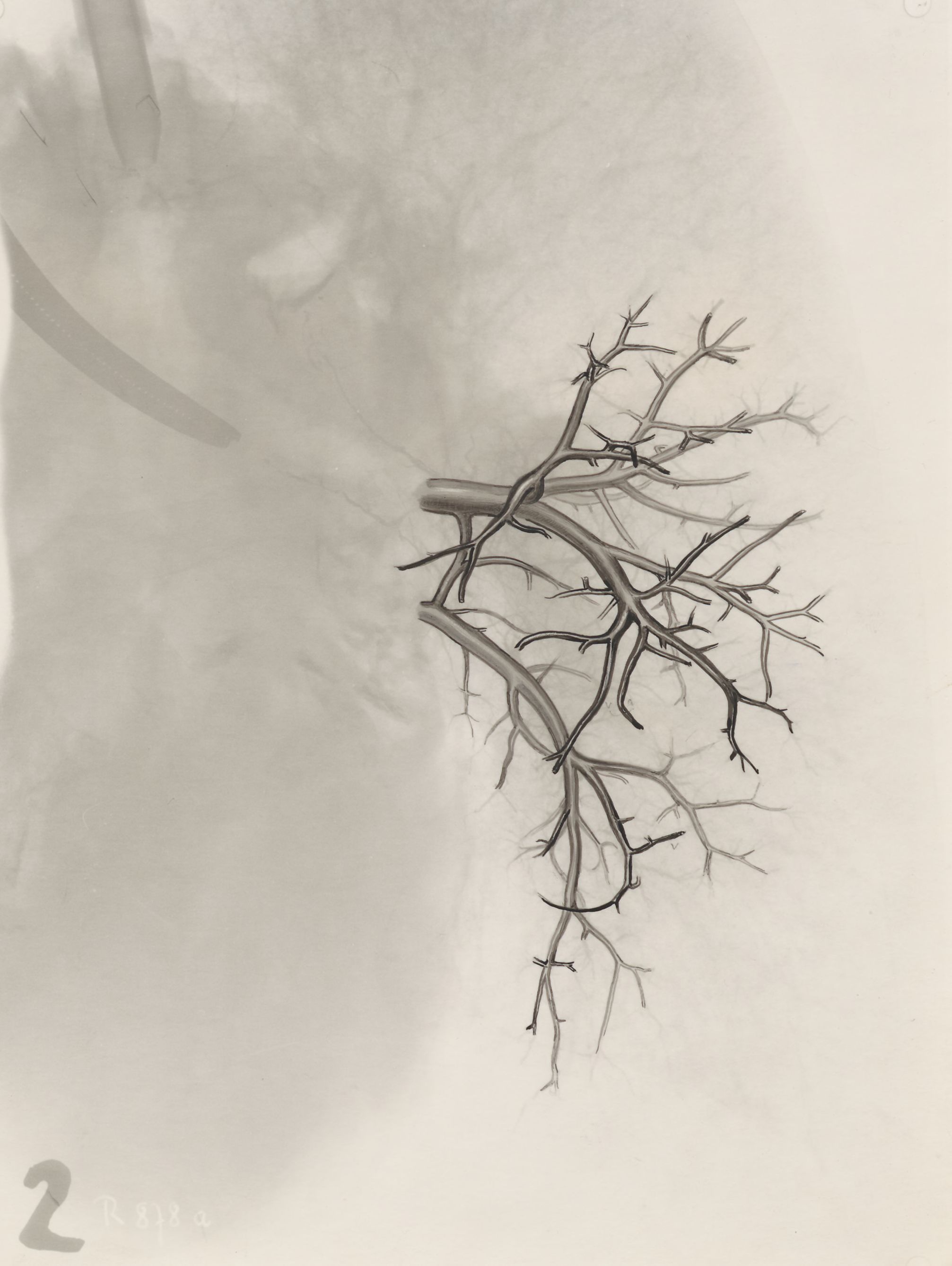 Bronchi