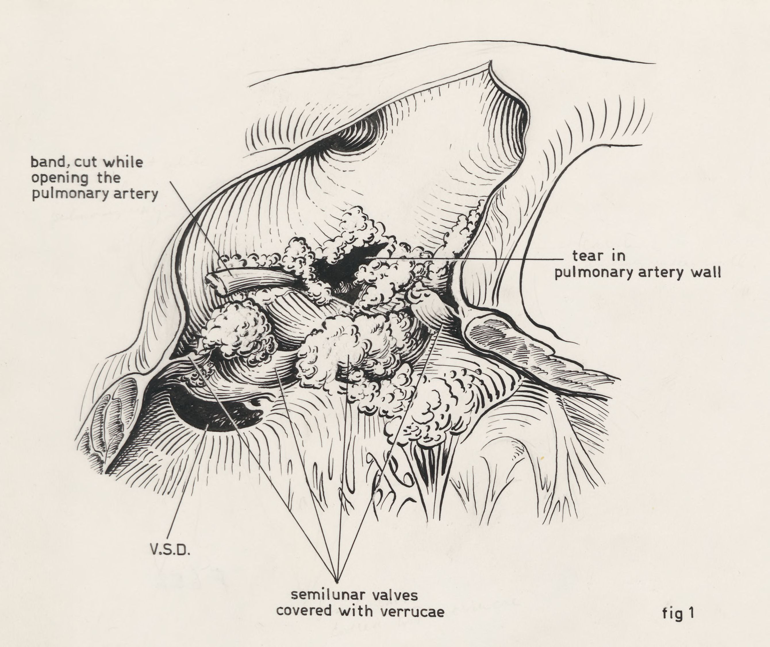 Embryonic heart